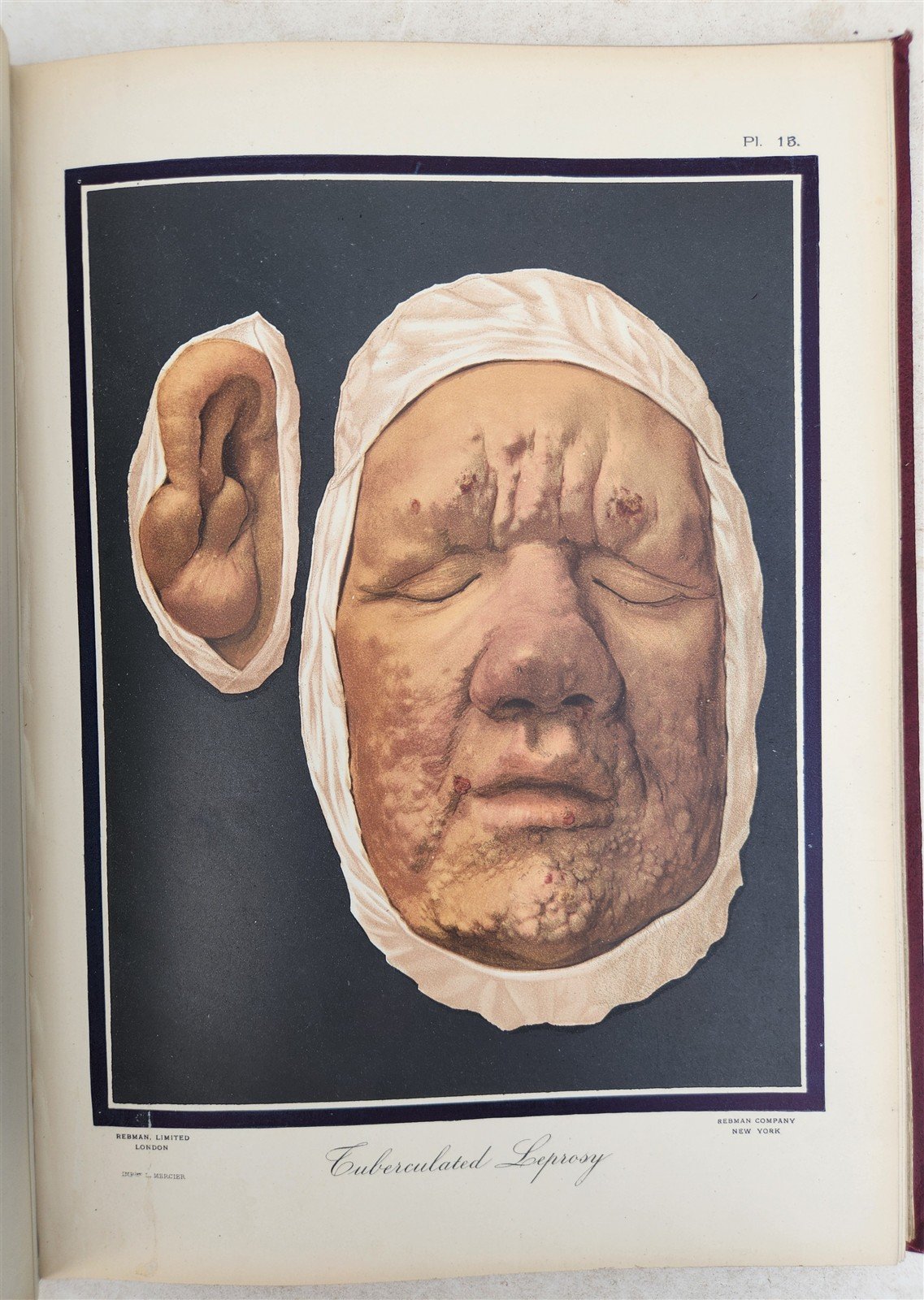 1895 PICTORIAL ATLAS of SKIN DISEASES & SYPHILITIC AFFECTION antique ILLUSTRATED