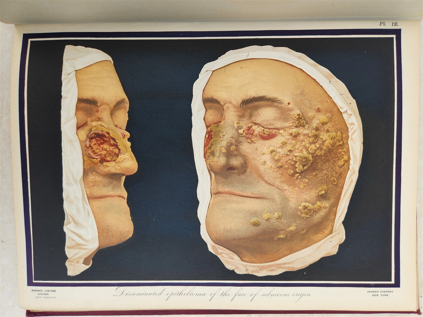 1895 PICTORIAL ATLAS of SKIN DISEASES & SYPHILITIC AFFECTION antique ILLUSTRATED