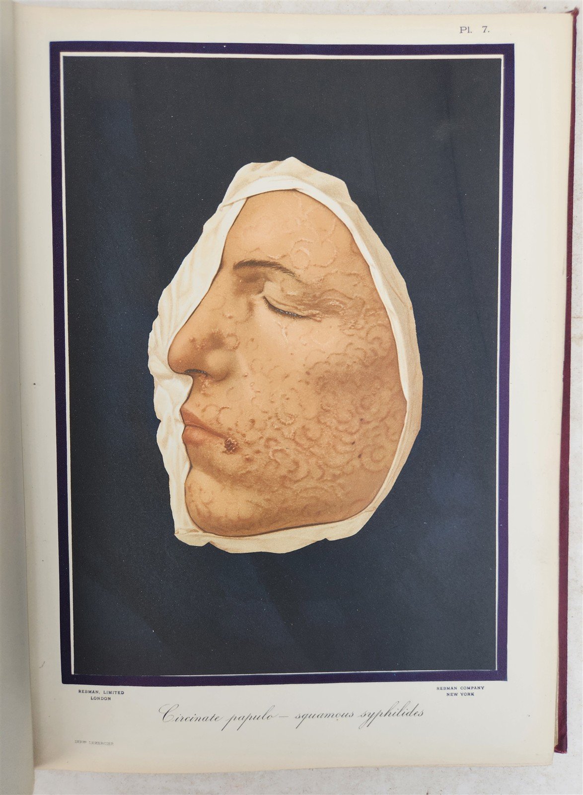 1895 PICTORIAL ATLAS of SKIN DISEASES & SYPHILITIC AFFECTION antique ILLUSTRATED