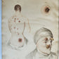 1814 ILLUSTRATED ESSAY on VENEREAL DISEASES confounded with Syphilis antique