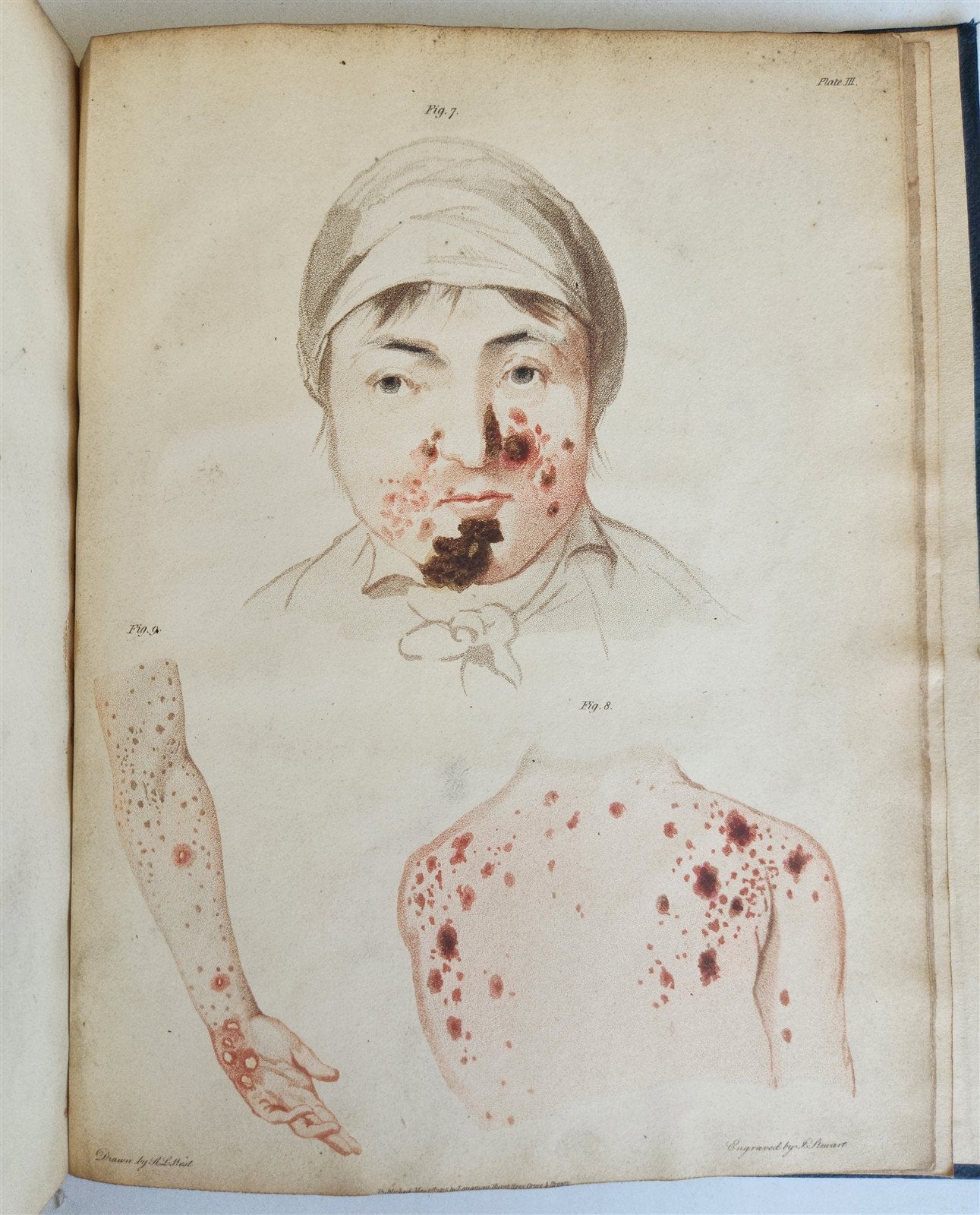 1814 ILLUSTRATED ESSAY on VENEREAL DISEASES confounded with Syphilis antique