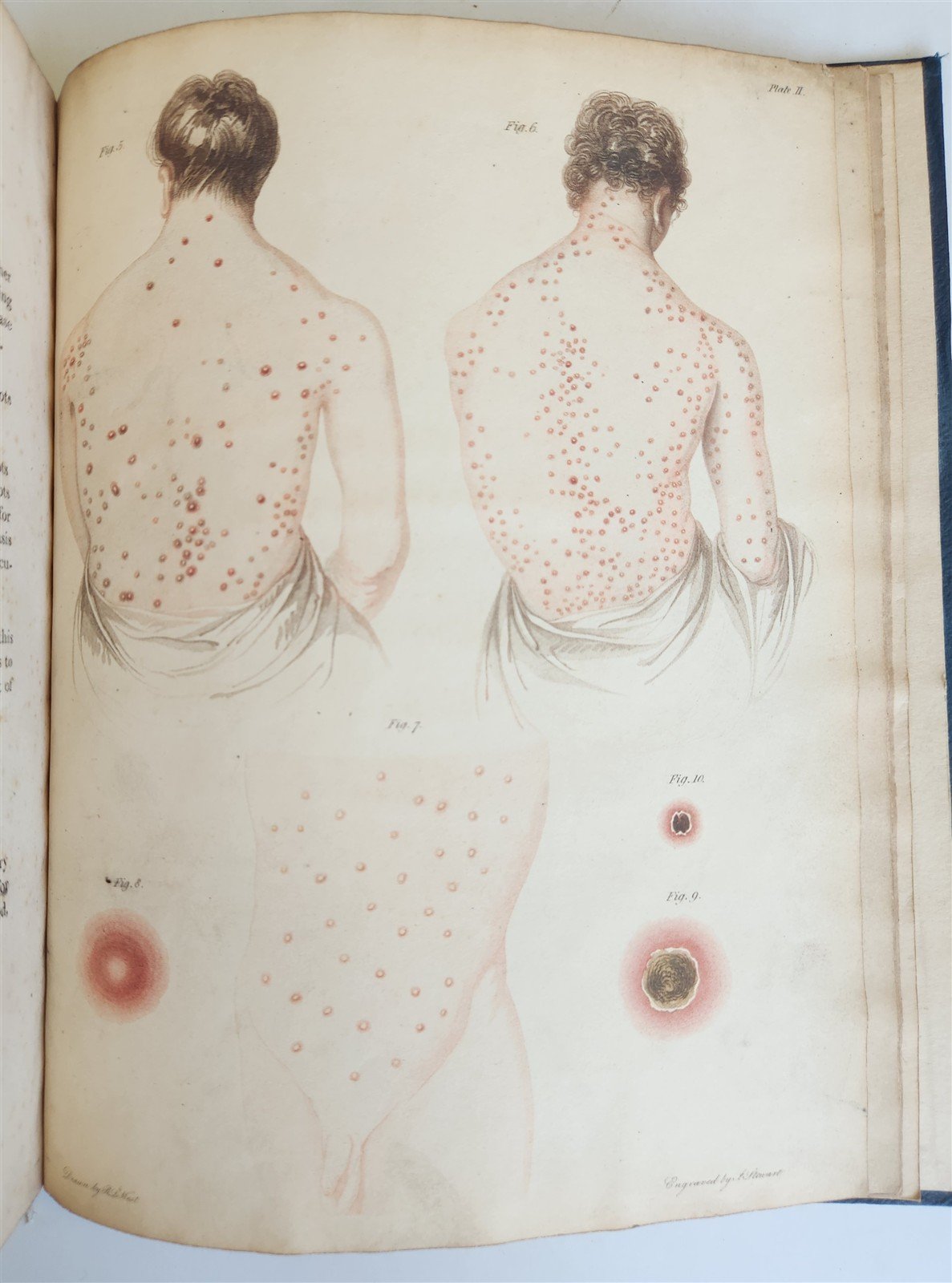 1814 ILLUSTRATED ESSAY on VENEREAL DISEASES confounded with Syphilis antique