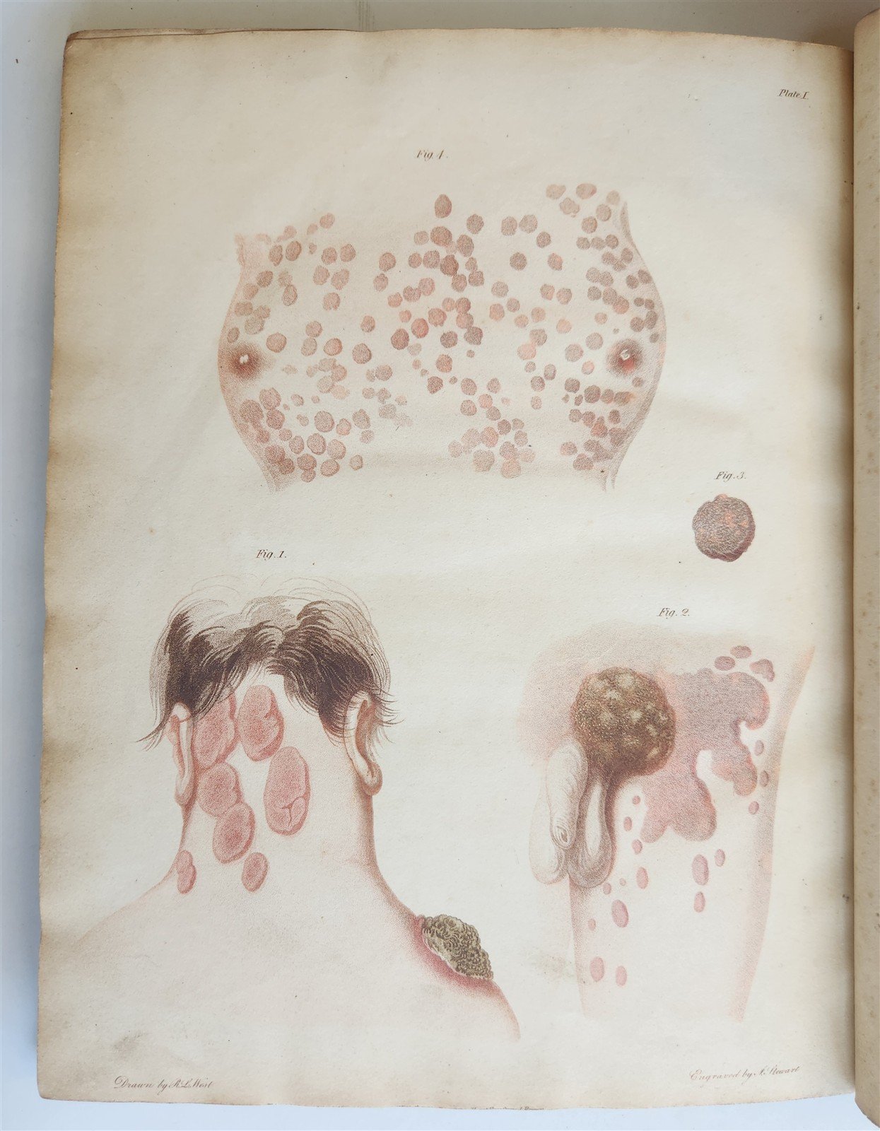 1814 ILLUSTRATED ESSAY on VENEREAL DISEASES confounded with Syphilis antique