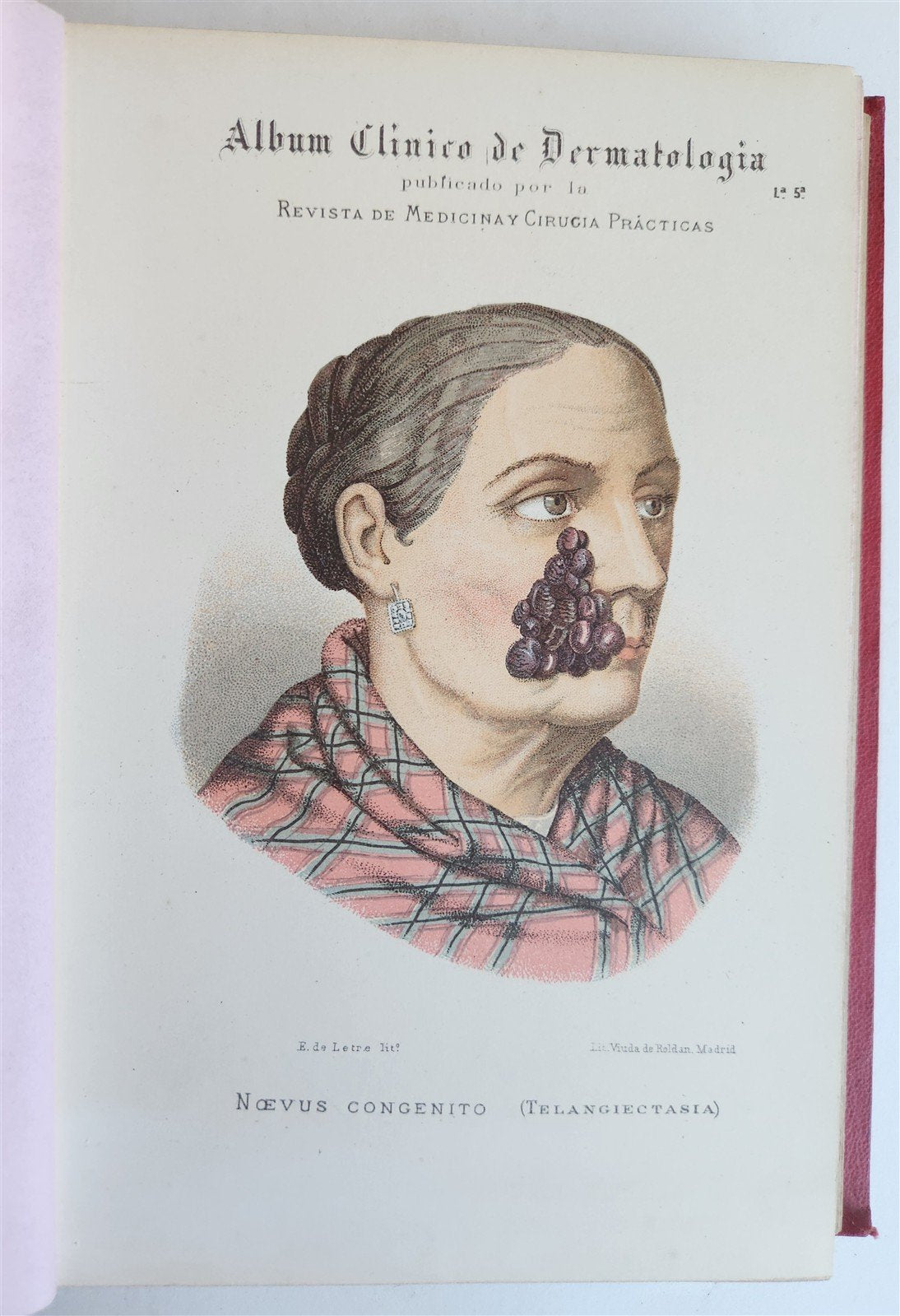1886 DERMATOLOGY ILLUSTRATED w/ 64 COLOR PLATES 2 VOLUMES in SPANISH antique