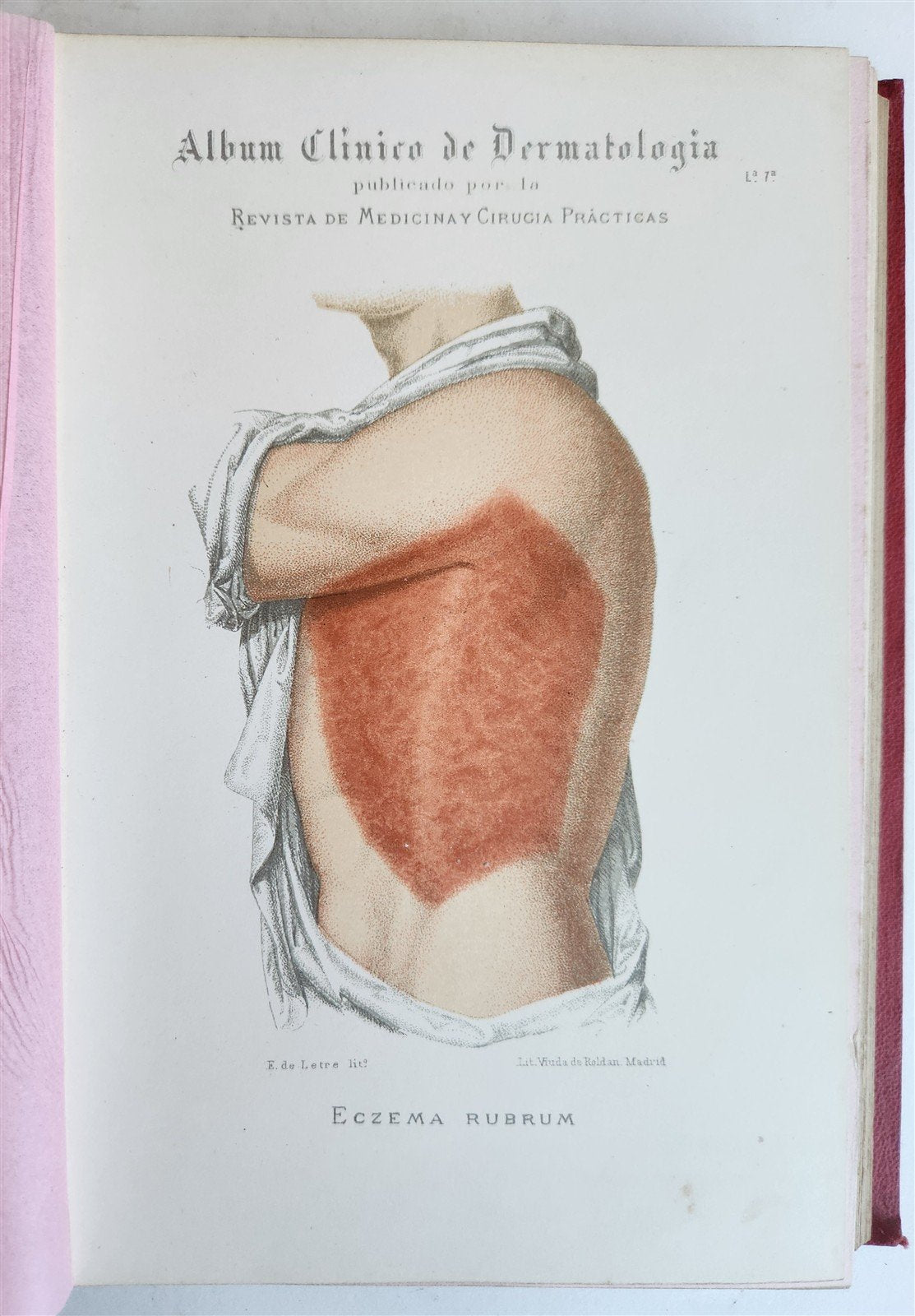 1886 DERMATOLOGY ILLUSTRATED w/ 64 COLOR PLATES 2 VOLUMES in SPANISH antique