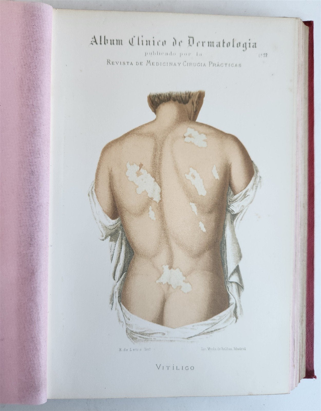 1886 DERMATOLOGY ILLUSTRATED w/ 64 COLOR PLATES 2 VOLUMES in SPANISH antique