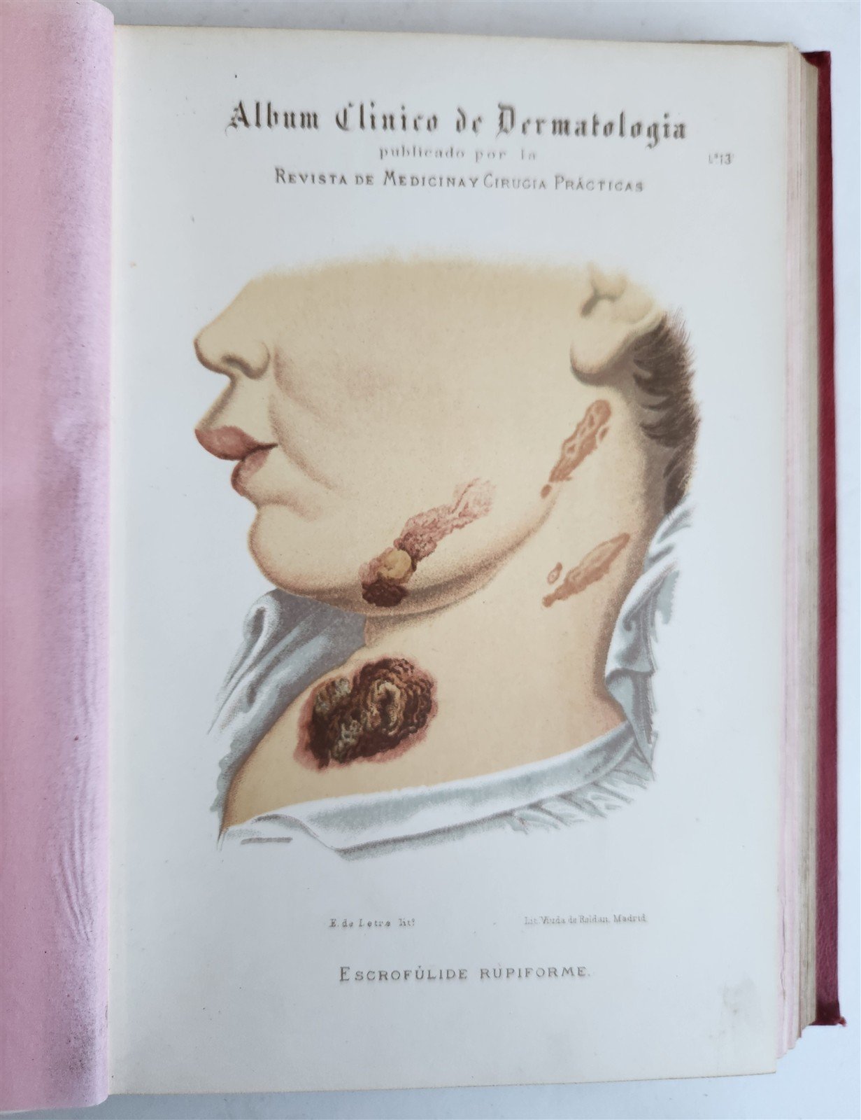 1886 DERMATOLOGY ILLUSTRATED w/ 64 COLOR PLATES 2 VOLUMES in SPANISH antique