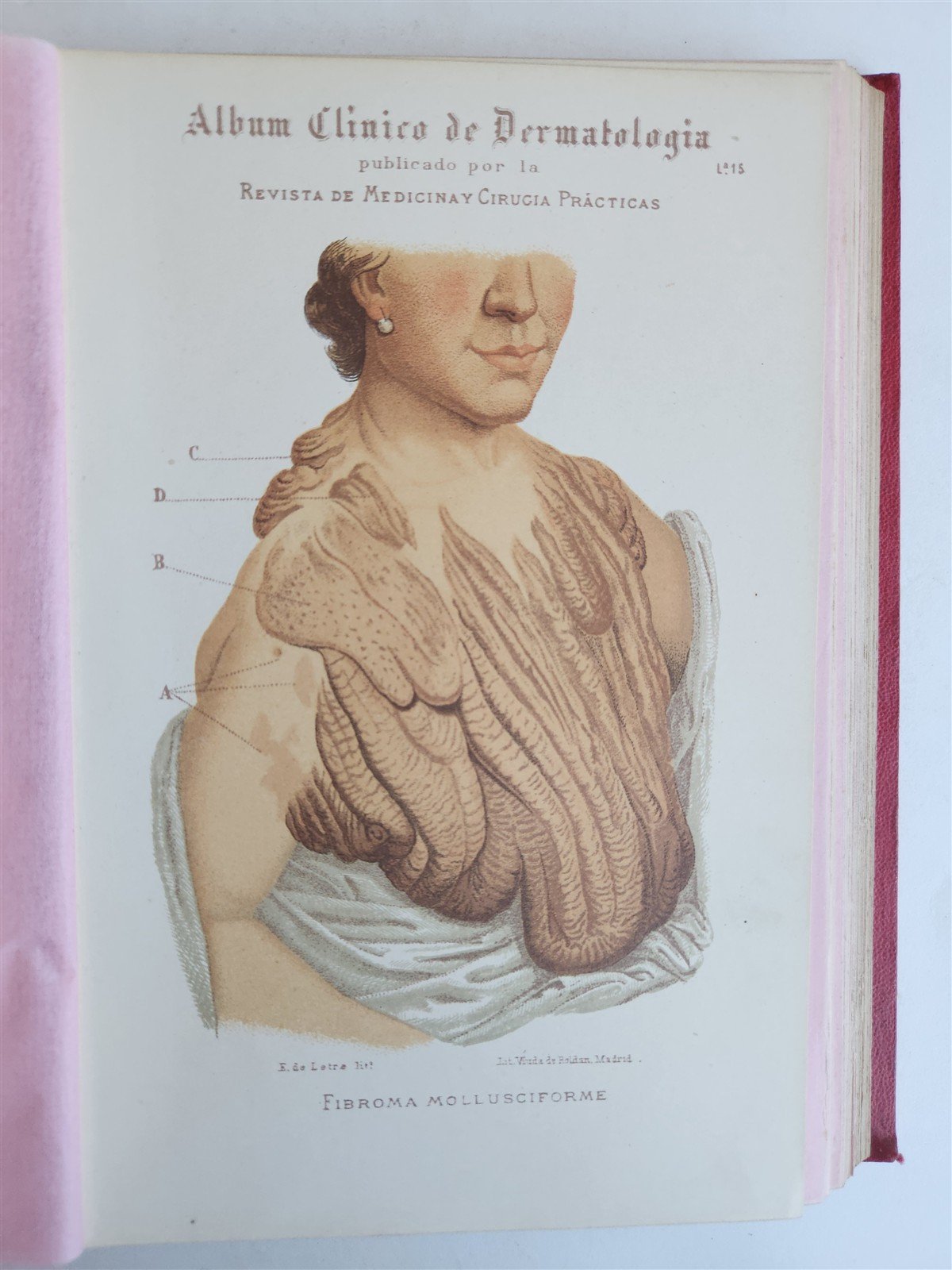 1886 DERMATOLOGY ILLUSTRATED w/ 64 COLOR PLATES 2 VOLUMES in SPANISH antique