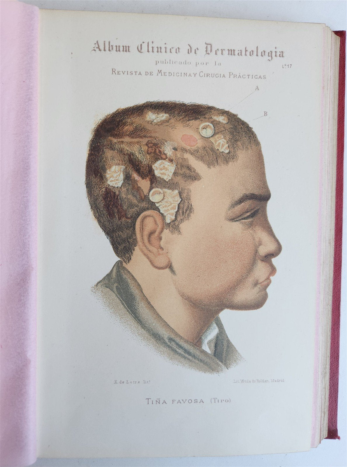 1886 DERMATOLOGY ILLUSTRATED w/ 64 COLOR PLATES 2 VOLUMES in SPANISH antique