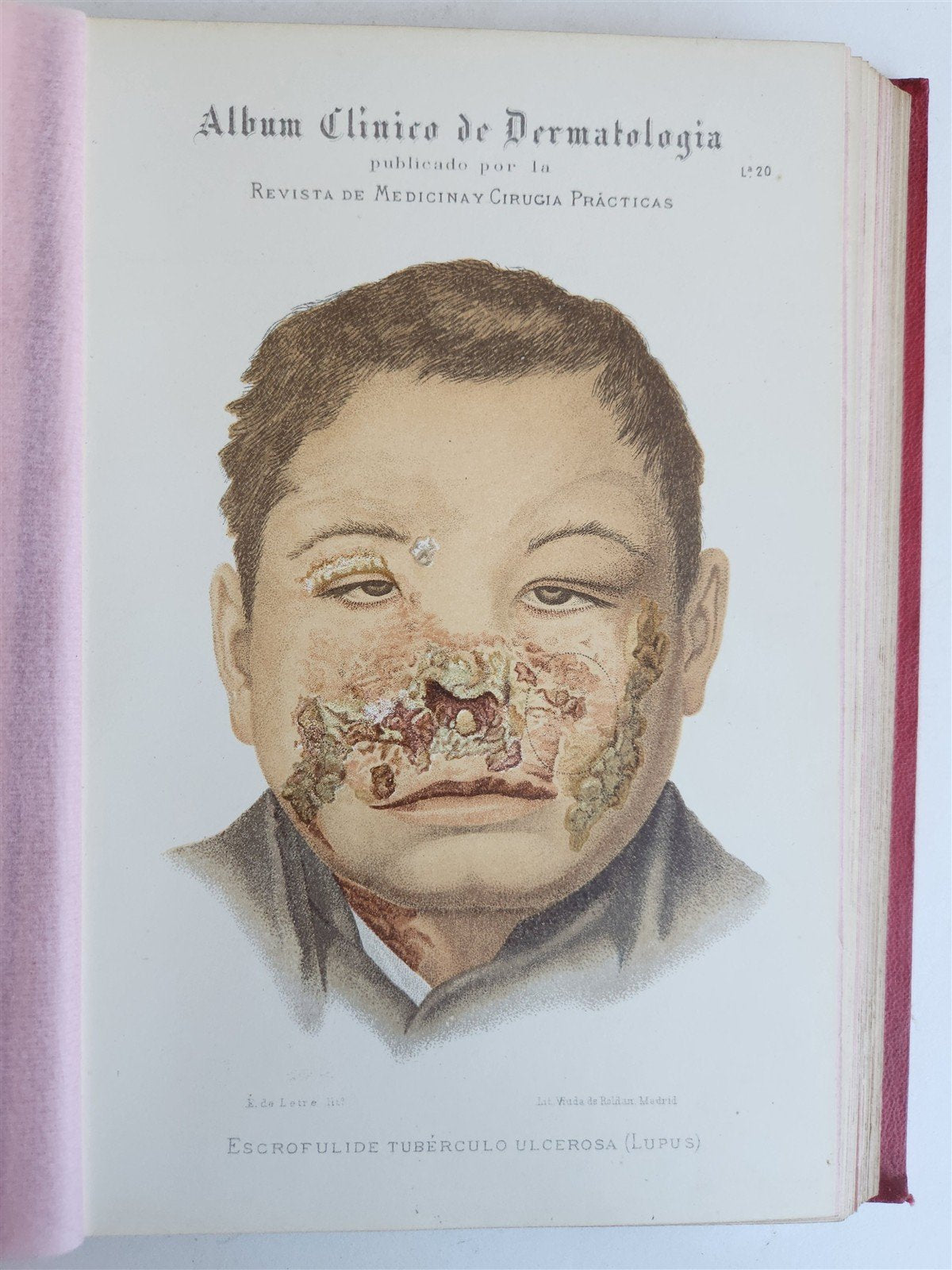 1886 DERMATOLOGY ILLUSTRATED w/ 64 COLOR PLATES 2 VOLUMES in SPANISH antique