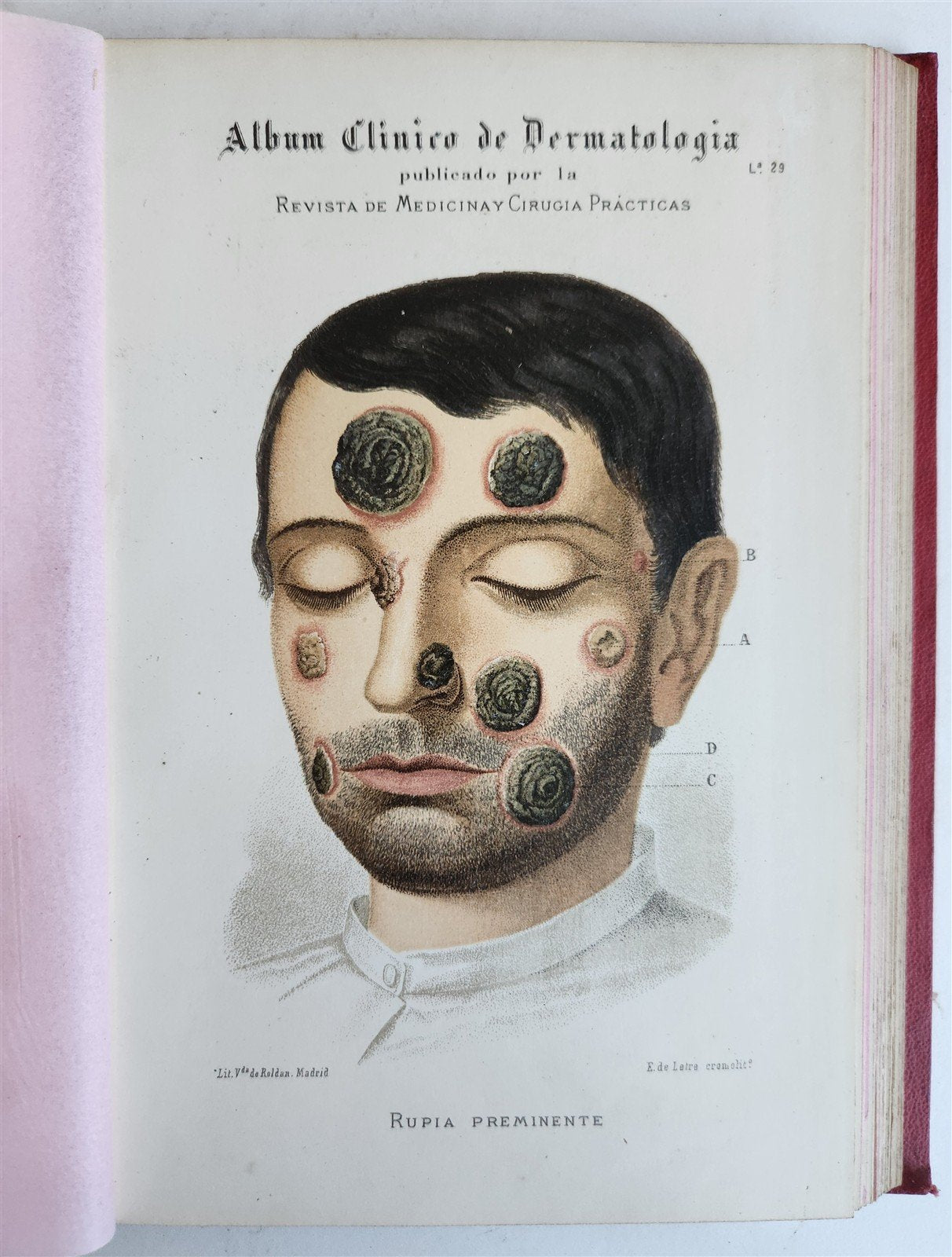 1886 DERMATOLOGY ILLUSTRATED w/ 64 COLOR PLATES 2 VOLUMES in SPANISH antique