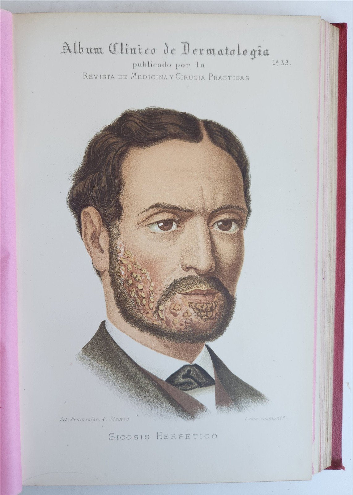 1886 DERMATOLOGY ILLUSTRATED w/ 64 COLOR PLATES 2 VOLUMES in SPANISH antique