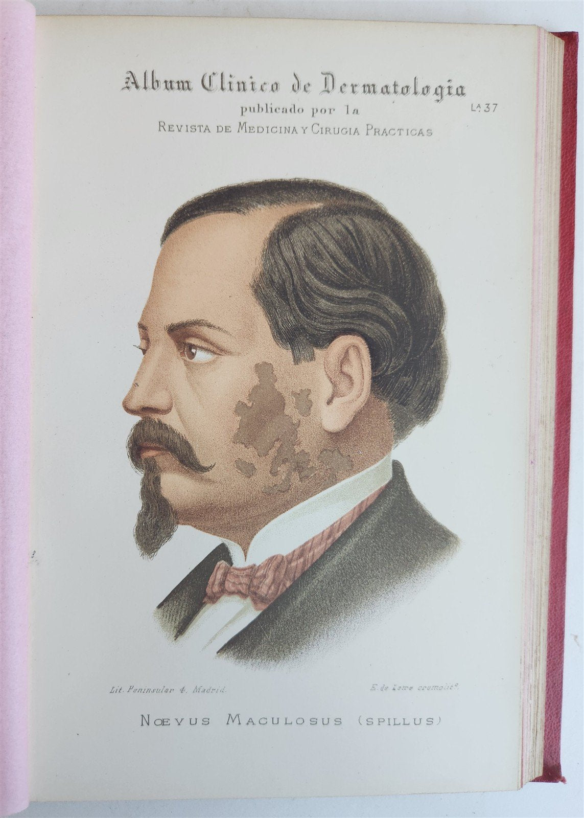 1886 DERMATOLOGY ILLUSTRATED w/ 64 COLOR PLATES 2 VOLUMES in SPANISH antique