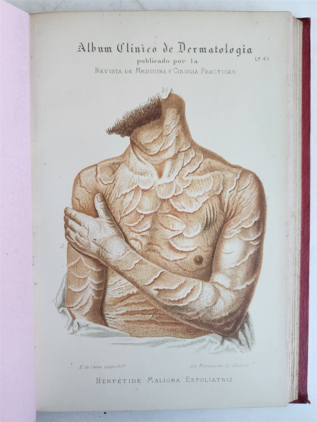 1886 DERMATOLOGY ILLUSTRATED w/ 64 COLOR PLATES 2 VOLUMES in SPANISH antique