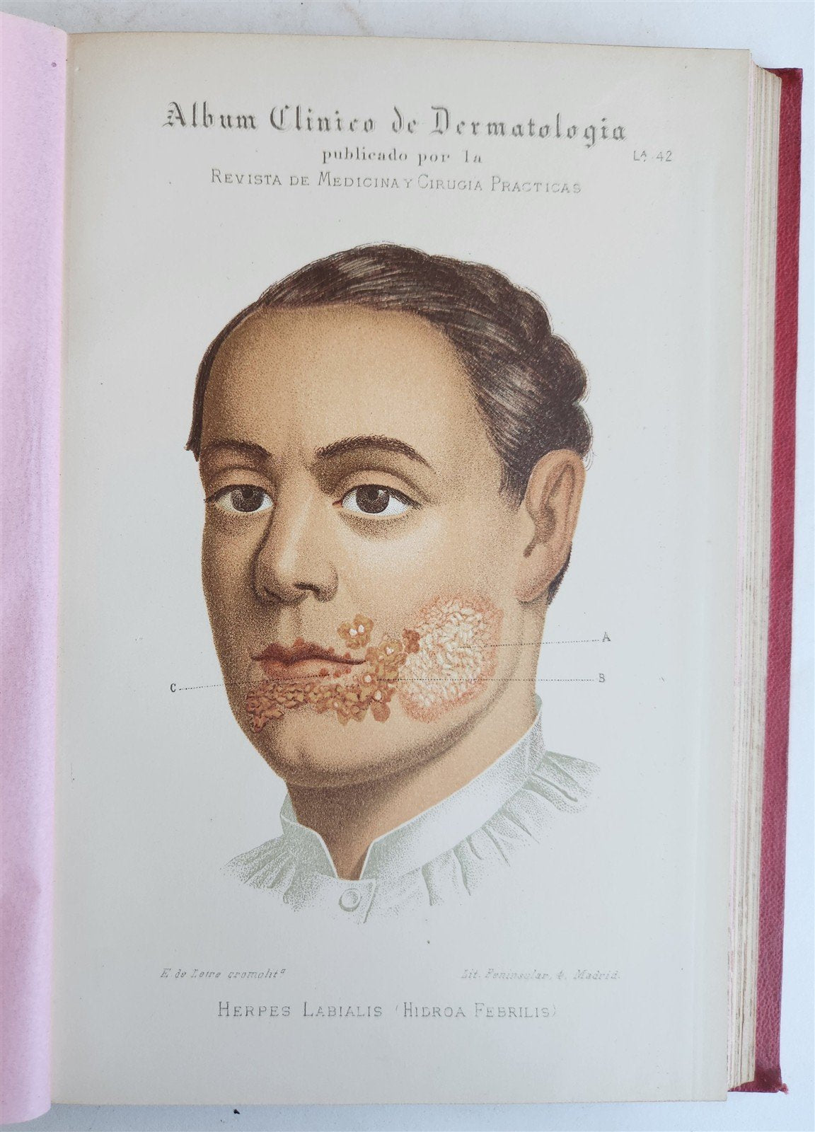1886 DERMATOLOGY ILLUSTRATED w/ 64 COLOR PLATES 2 VOLUMES in SPANISH antique