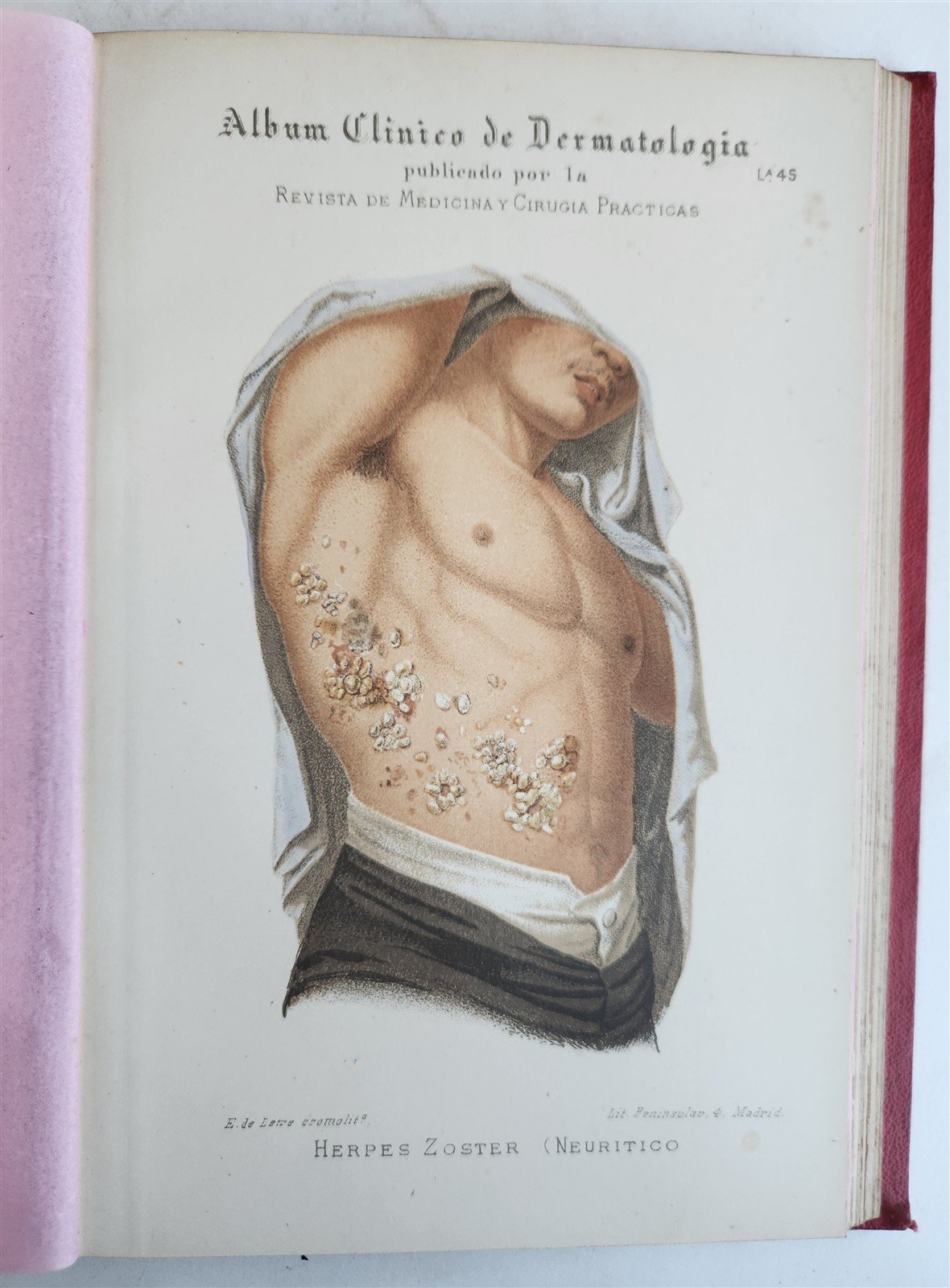 1886 DERMATOLOGY ILLUSTRATED w/ 64 COLOR PLATES 2 VOLUMES in SPANISH antique
