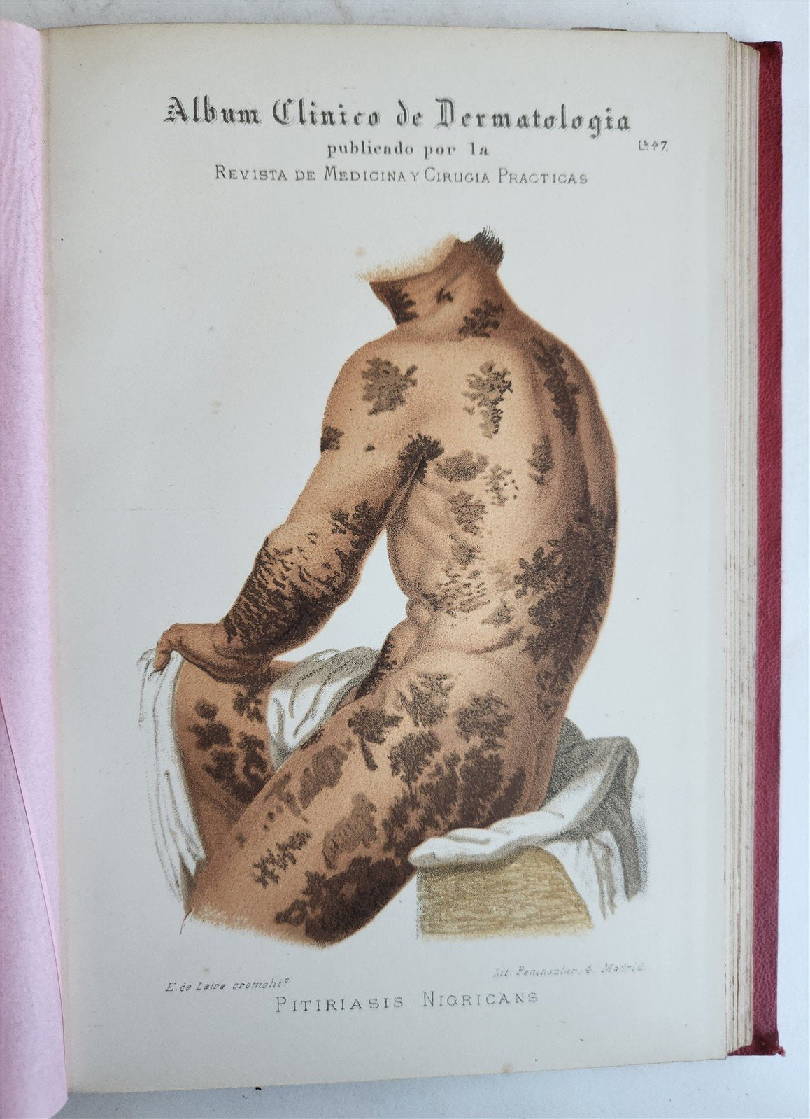 1886 DERMATOLOGY ILLUSTRATED w/ 64 COLOR PLATES 2 VOLUMES in SPANISH antique