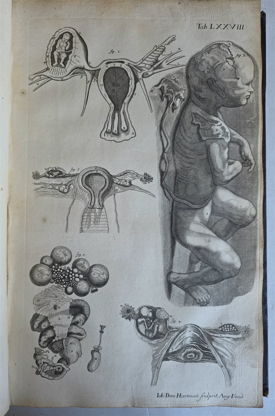 1717 ANATOMICAL TREATISE Theatrum Anatomicum ILLUSTRATED 2 FOLIO VOLUMES antique
