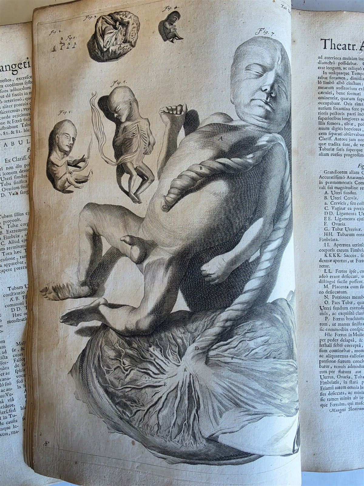 1717 ANATOMICAL TREATISE Theatrum Anatomicum ILLUSTRATED 2 FOLIO VOLUMES antique