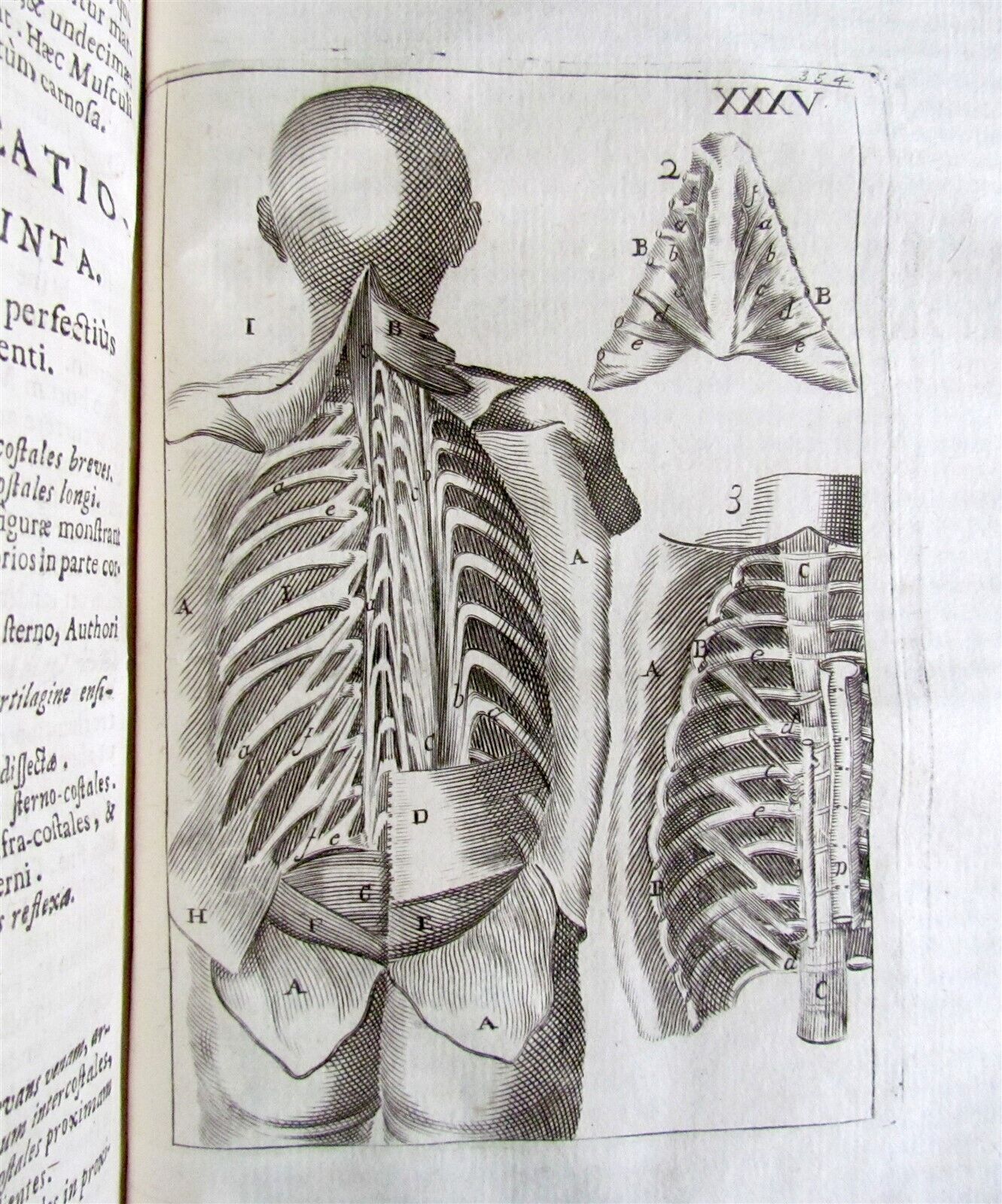 1717 2 VOLUMES ANATOMY ILLUSTRATED CORPORIS HUMANI ANATOMIAE antique in LATIN