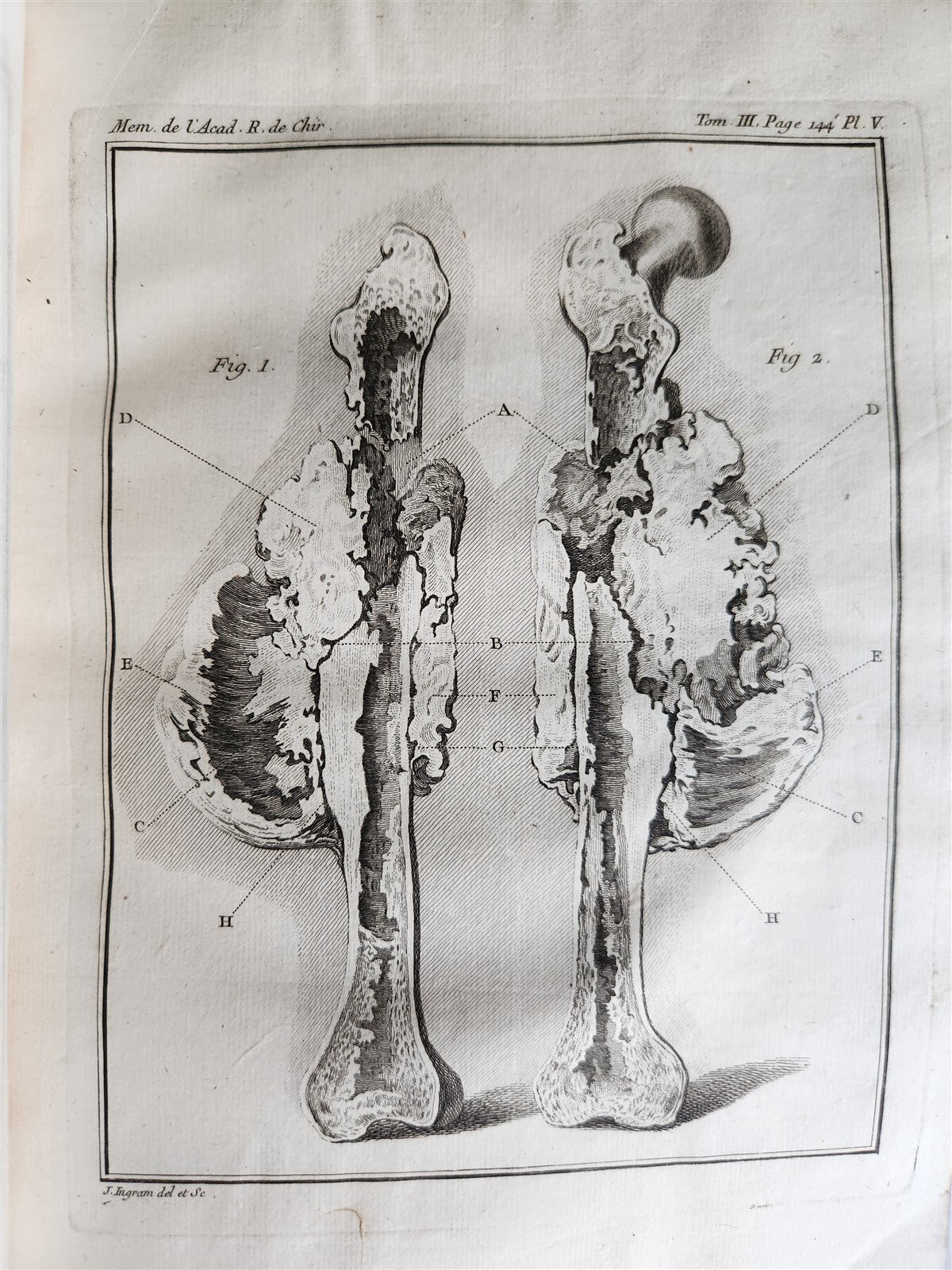 1753 SURGERY ANATOMY ILLUSTRATED antique Memoires l'Academie Royale de Chirurgie