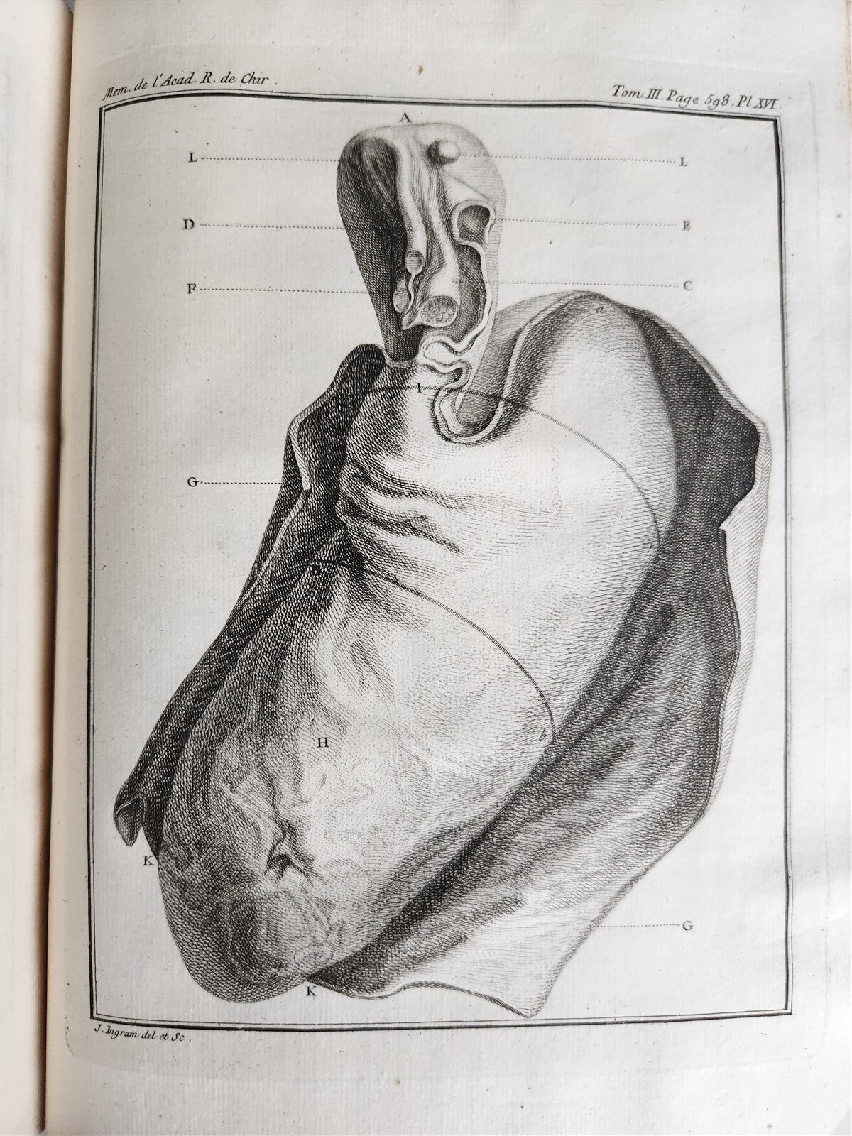 1753 SURGERY ANATOMY ILLUSTRATED antique Memoires l'Academie Royale de Chirurgie