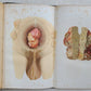 1865-82 SURGERY & ANATOMY 13 volumes FULLY ILLUSTRATED antique in GERMAN