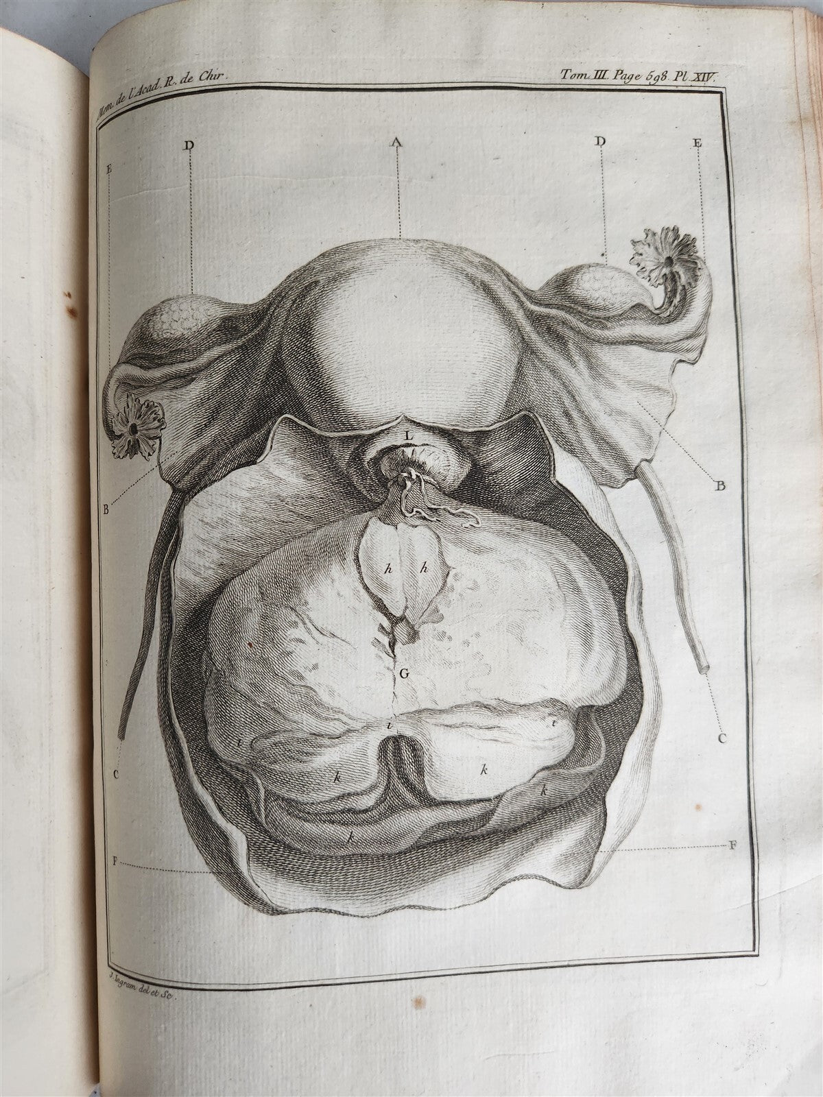 1753 SURGERY ANATOMY ILLUSTRATED antique Memoires l'Academie Royale de Chirurgie