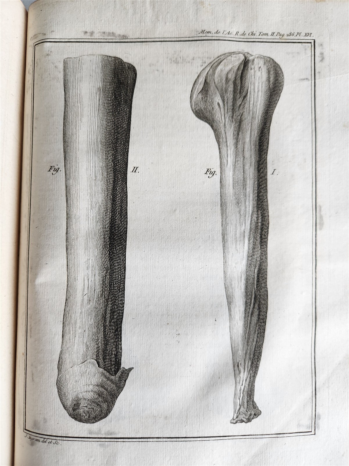 1757 SURGERY ANATOMY ILLUSTRATED antique Memoires l'Academie Royale de Chirurgie